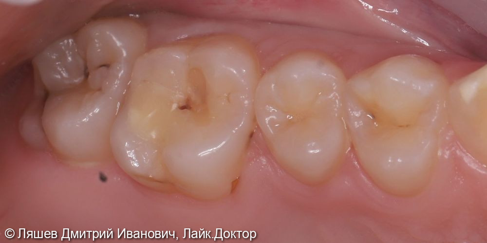 Лечение кариеса дентина зуба 1.6 - фото №1