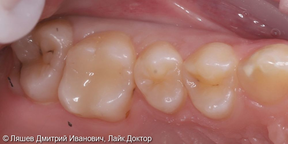 Лечение кариеса дентина зуба 1.6 - фото №2