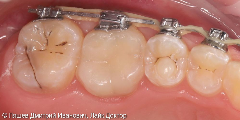 Лечение кариеса дентина зуба 1.6 - фото №2