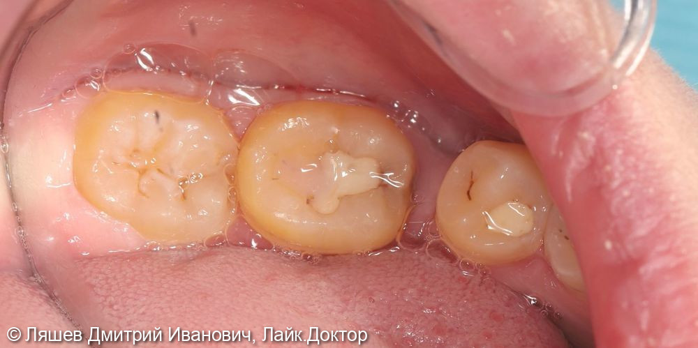 Лечение кариеса дентина зуба 3.6 - фото №1