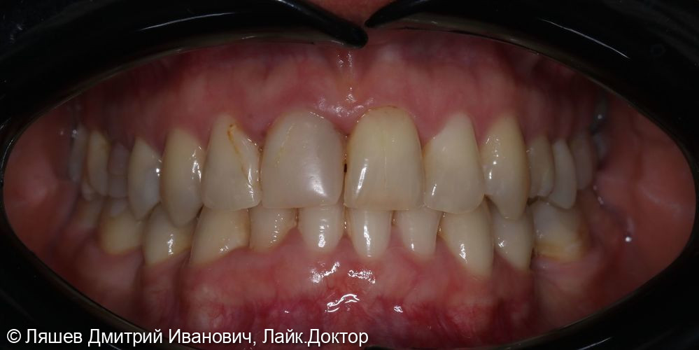 Установка керамических виниров на зубы верхней челюсти - фото №1