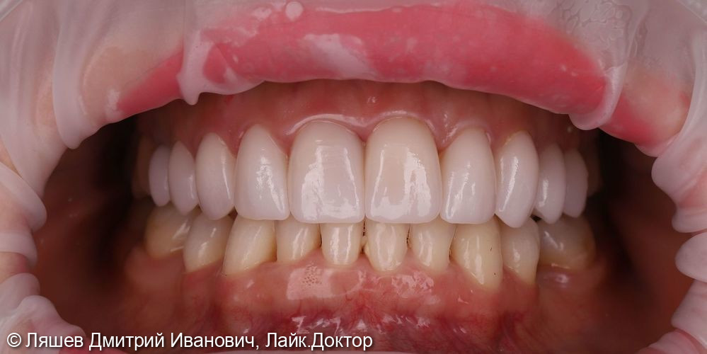 Установка керамических виниров на зубы верхней челюсти фото 2 · Вологда
