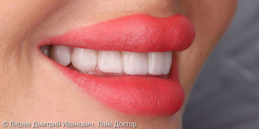 Установка керамических виниров на зубы верхней челюсти - фото №3