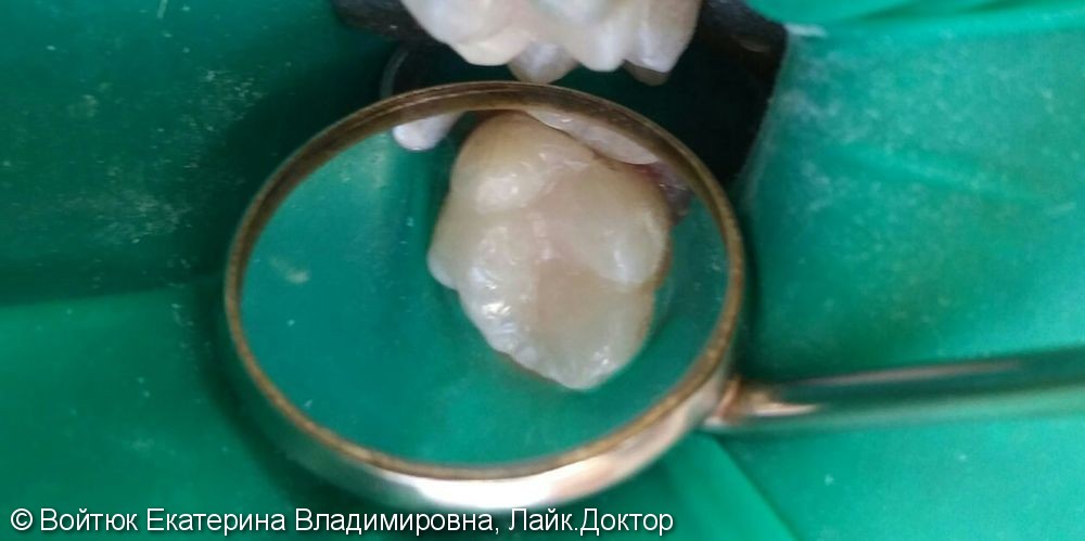 Лечение глубокого кариеса жевательного зуба 2.6, до и после - фото №2
