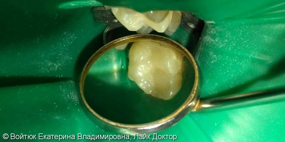 Лечение глубокого кариеса жевательного зуба 2.6, до и после - фото №3