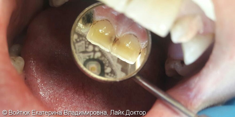 Лечение среднего кариеса 1.1 и 2.1 зубов. - фото №1