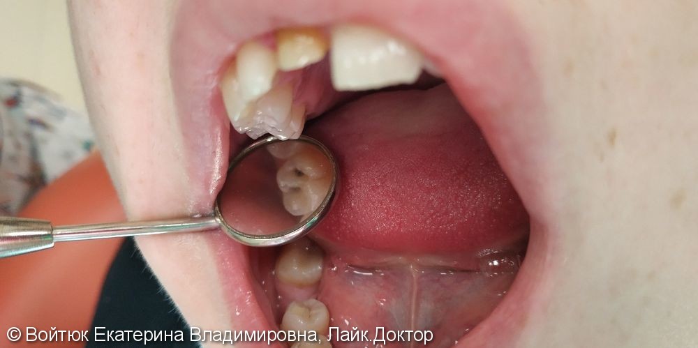 Лечение глубокого кариеса жевательного зуба 1.6. - фото №1