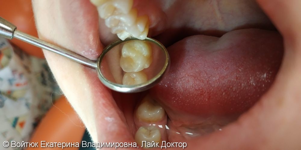 Лечение глубокого кариеса жевательного зуба 1.6. - фото №3