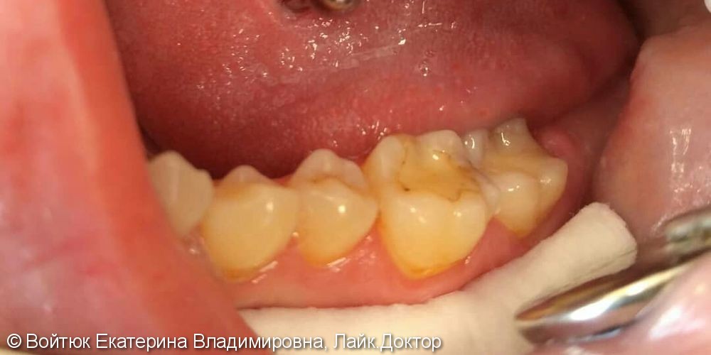 Лечение глубокого кариеса жевательного зуба 3.6,  лечение клиновидных дефектов зубов 3.5 и 3.4 - фото №1