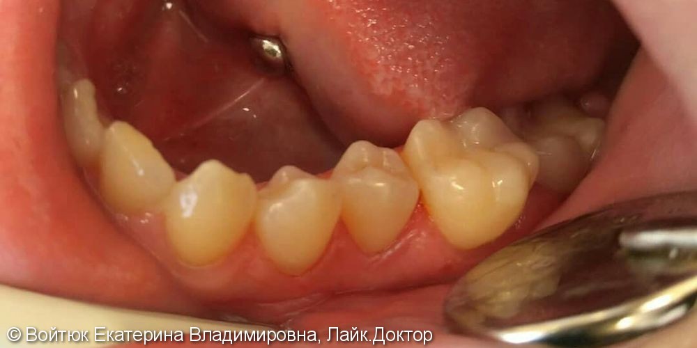 Лечение глубокого кариеса жевательного зуба 3.6,  лечение клиновидных дефектов зубов 3.5 и 3.4 - фото №2