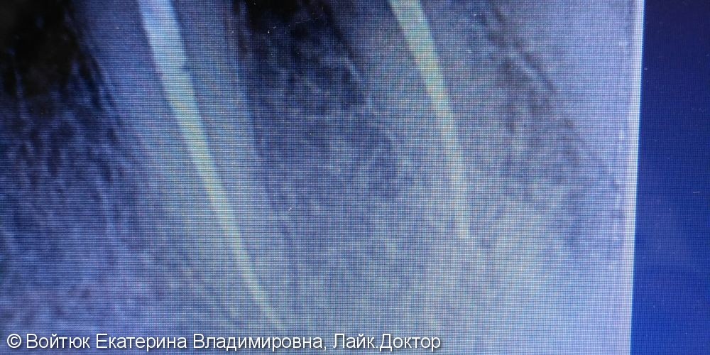 Лечение хронического фиброзного пульпита 2.2 и 2.3 зубов - фото №2