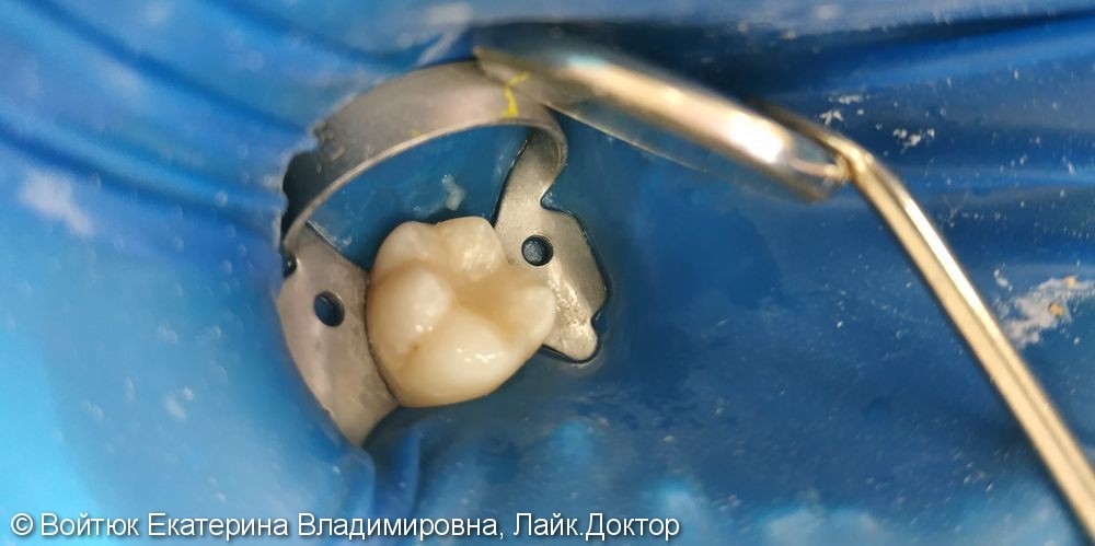 Лечение глубокого кариеса 4.6 зуба - фото №3