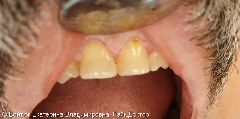 Реставрация переднего зуба 1.1 - фото №2