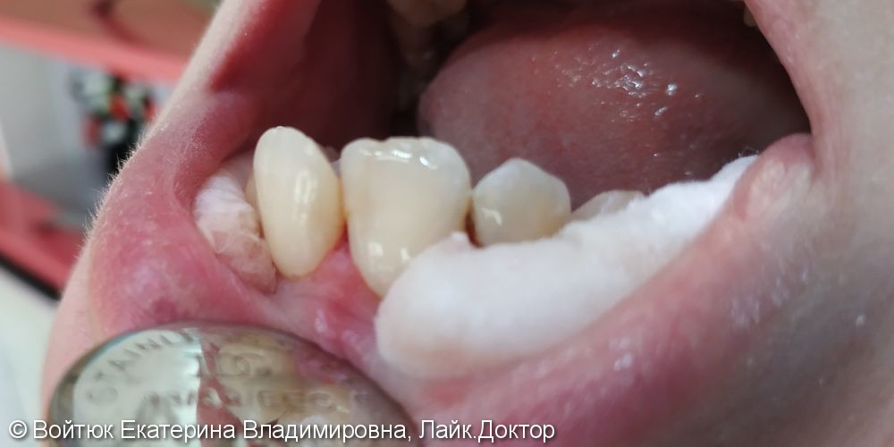 Лечение глубокого кариеса зуба 2,1 - фото №2