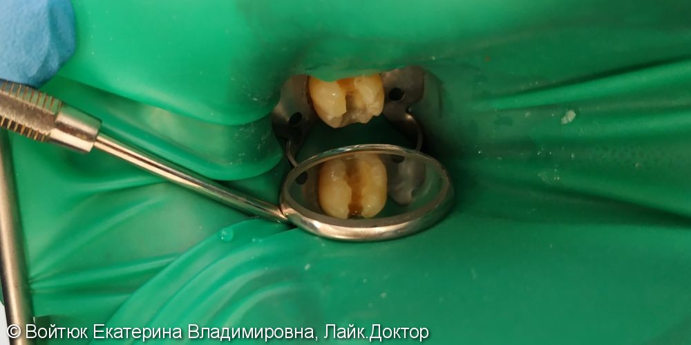 Лечение глубокого кариеса зуба 3.7 - фото №2