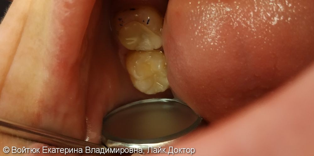Лечение глубокого кариеса зуба 3.7 - фото №3