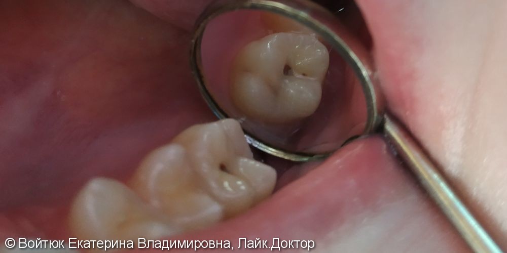 Лечение среднего кариеса зуба 1.7 - фото №1
