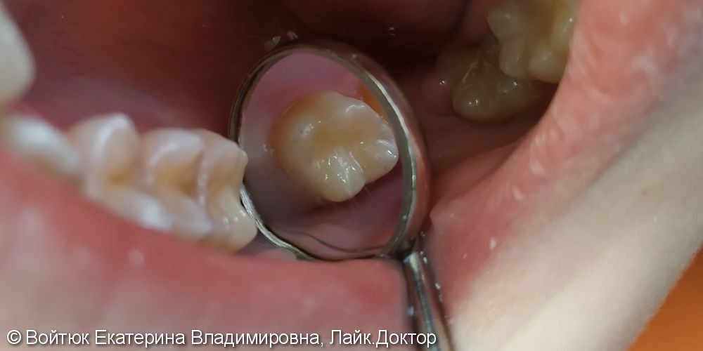 Лечение среднего кариеса зуба 1.7 - фото №2