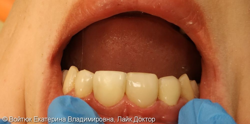 Реставрация передних зубов 1.2, 1.1, 2.1, 2.2 - фото №1