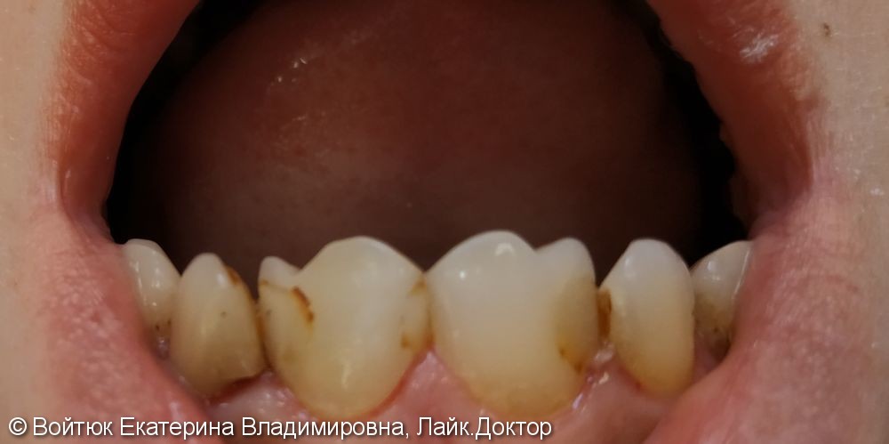 Реставрация передних зубов 1.2, 1.1, 2.1, 2.2 - фото №2