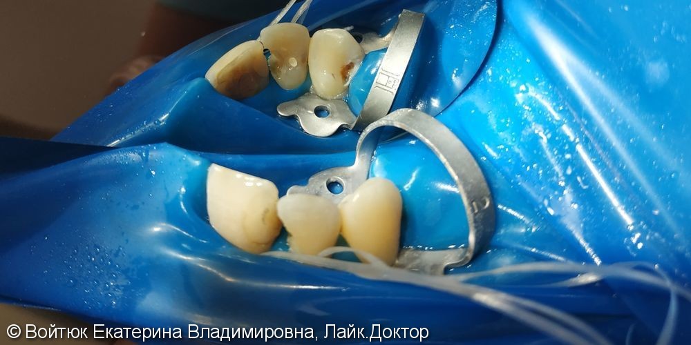 Лечение глубокого кариеса зубов 1.2, 1.3 - фото №2