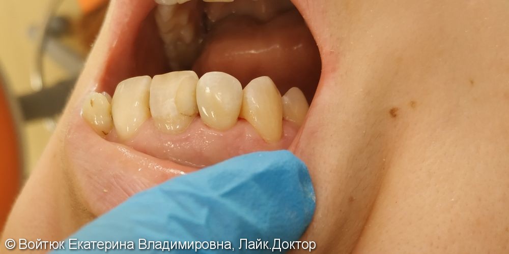 Лечение глубокого кариеса зубов 1.2, 1.3 - фото №3