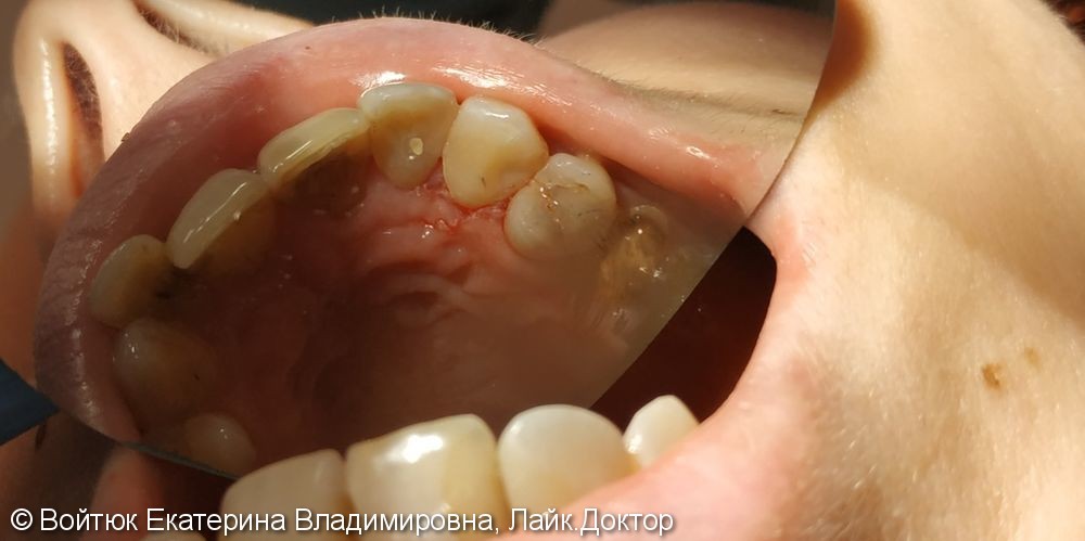 Лечение глубокого кариеса зубов 1.2, 1.3 - фото №4