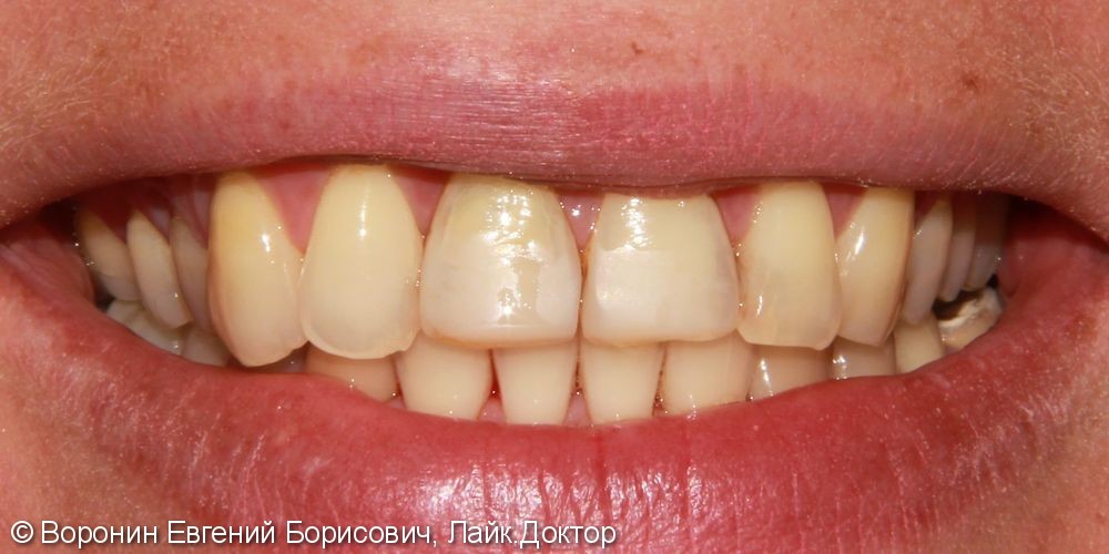 Боль при накусывании, подвижность зуба, фото до и после - фото №1