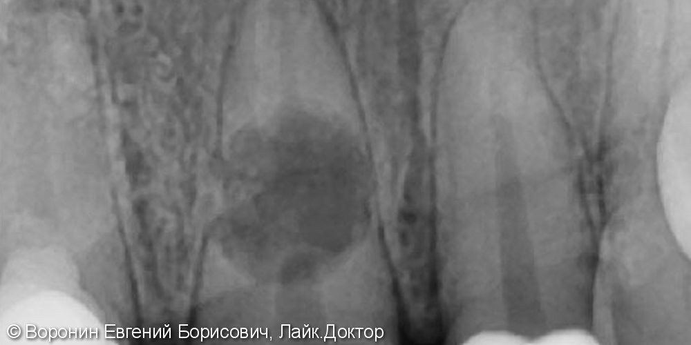 Боль при накусывании, подвижность зуба, фото до и после - фото №2
