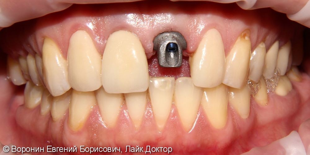 Боль при накусывании, подвижность зуба, фото до и после - фото №5
