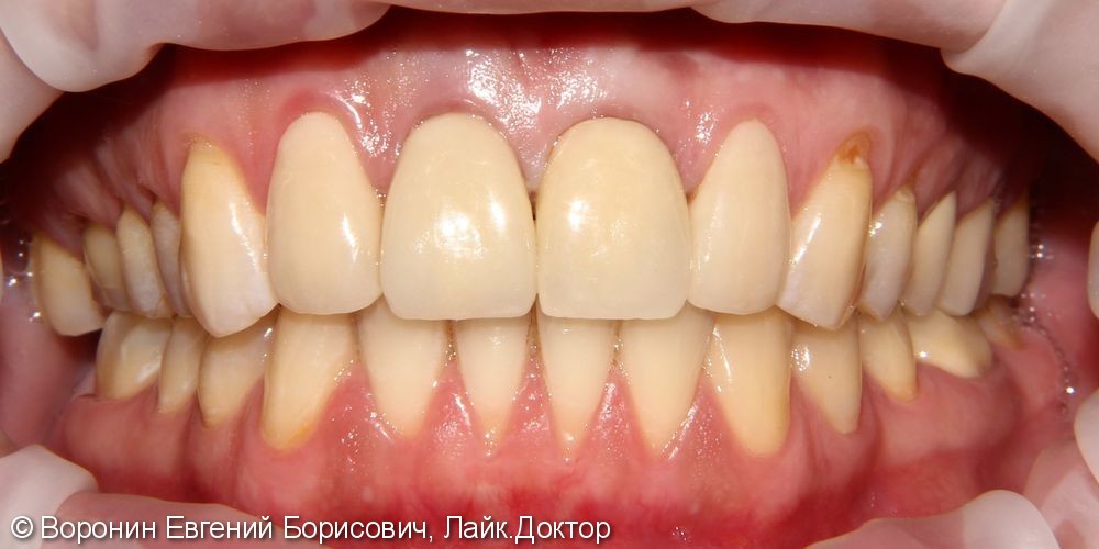 Боль при накусывании, подвижность зуба, фото до и после - фото №6