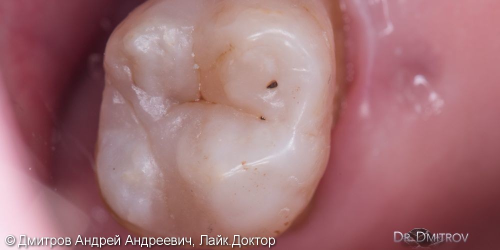 Восстановление зуба материалом Estelite Asteria A3B OcE - фото №5