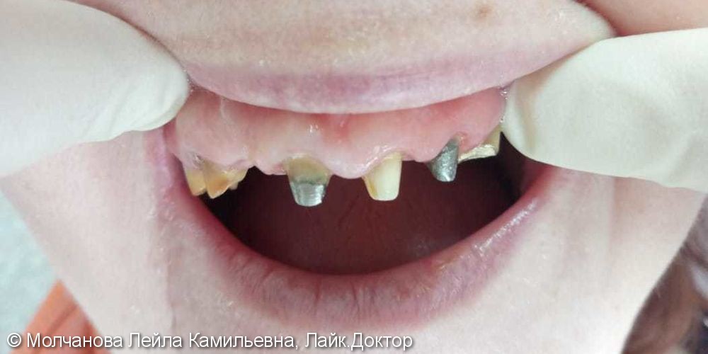 Металлокерамические коронки на передние зубы - фото №1