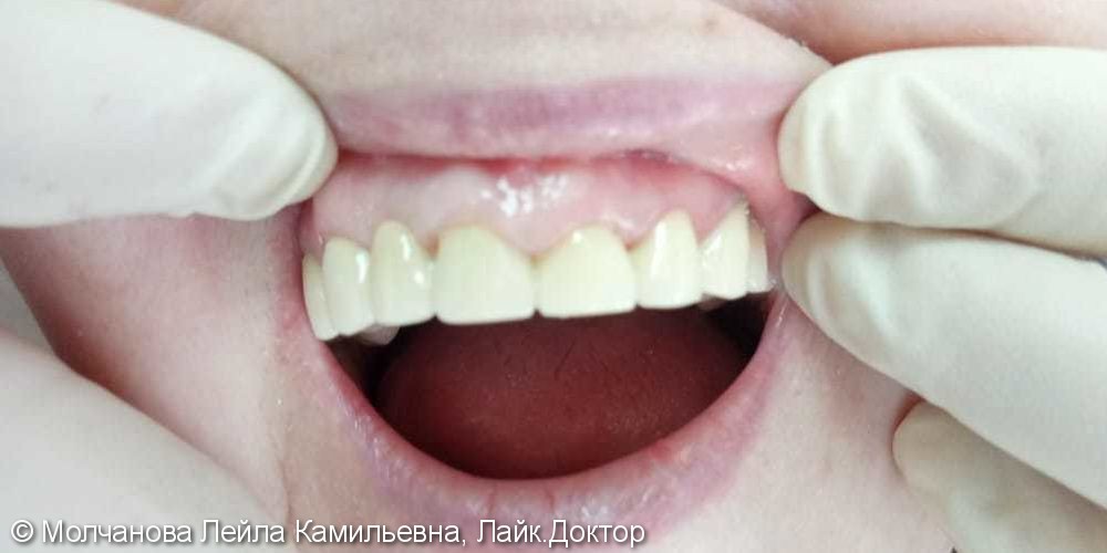 Протезирование испорченных зубов - фото №2