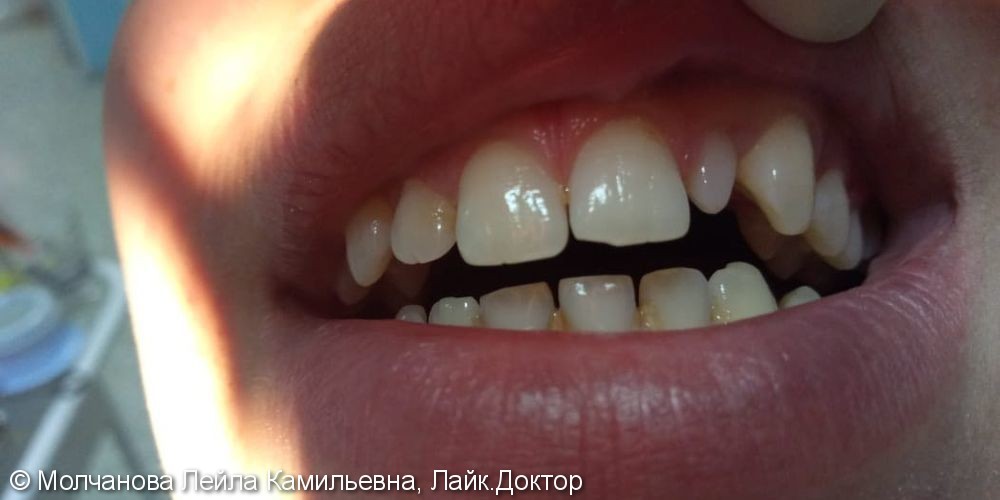 Результат протезирования шиловидного зуба, фото до и после - фото №1