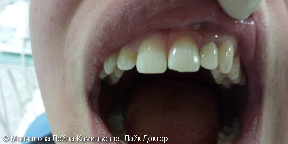 Результат протезирования шиловидного зуба, фото до и после - фото №2