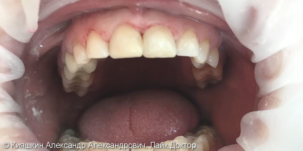 Контактный кариес 11 и 21 зубов, клиновидный дефект 12 и 11 зубов - фото №2