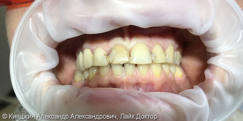 Вторичный кариес 12, 11, 22 и 23 зубов, контактный кариес 21 зуба - фото №1