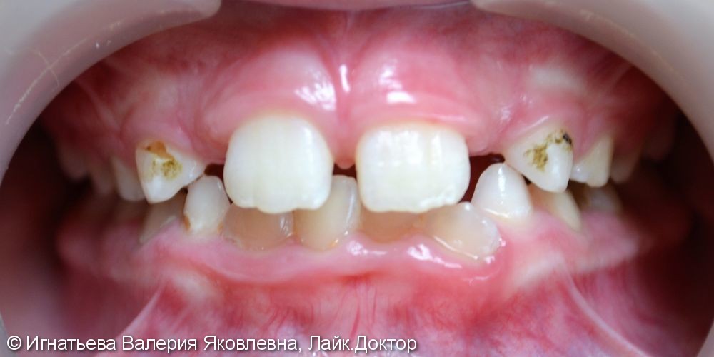 Лечение кариеса молочных зубов материалом Filtek Z250 - фото №1