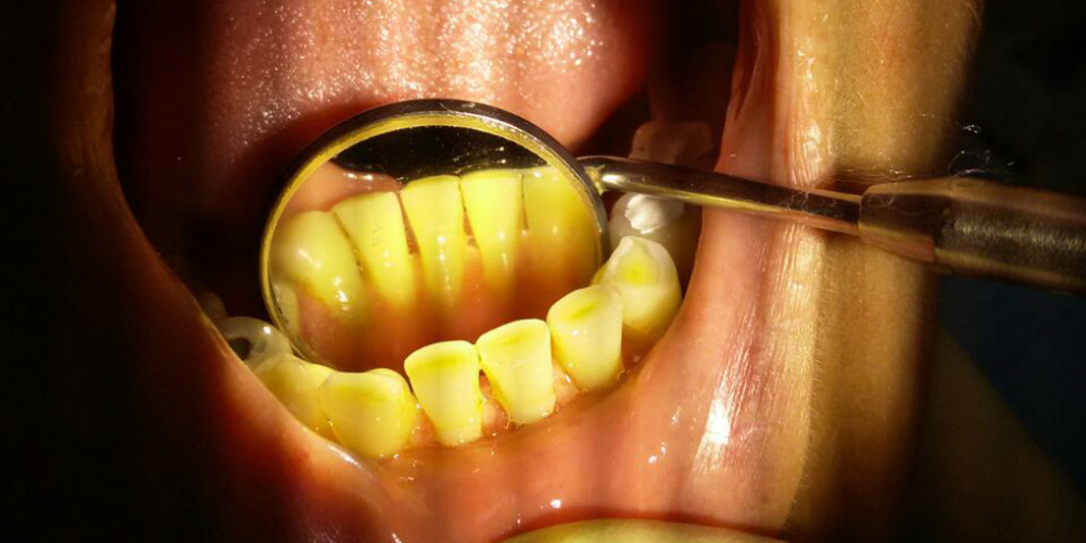 Снятие наддесневого зубного камня при помощи ультразвука - фото №2