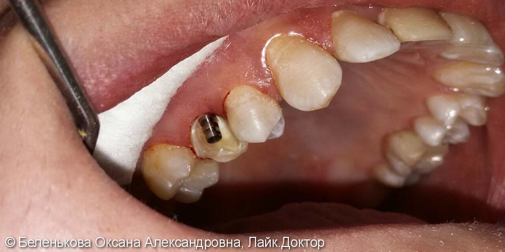 Раскололась коронковая часть зуба из-за обширной кариозной полости - фото №1
