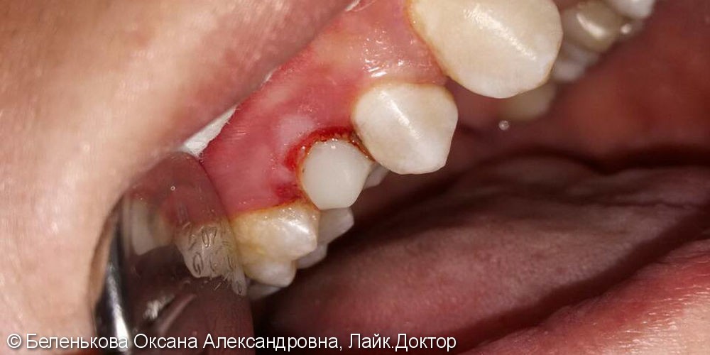 Раскололась коронковая часть зуба из-за обширной кариозной полости - фото №3