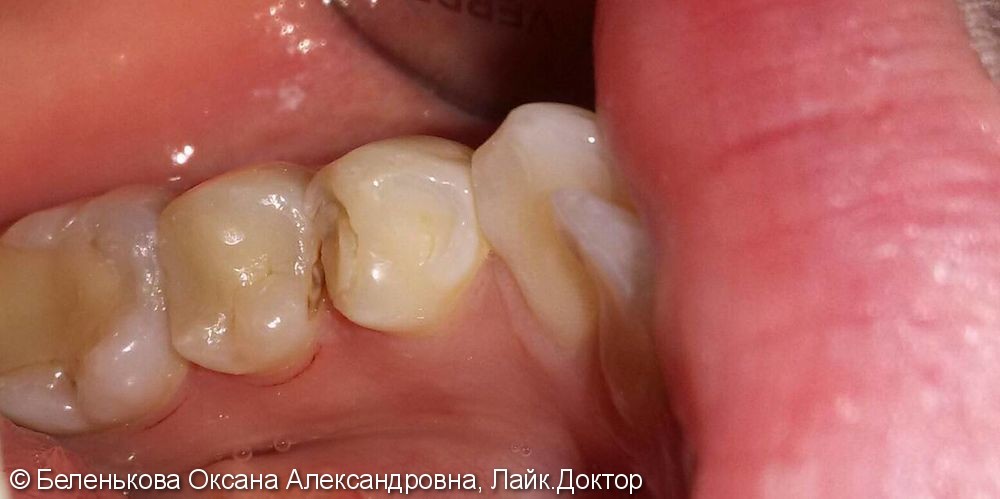 Лечение кариеса двух зубов 3.4 и 3.5, до и после - фото №1
