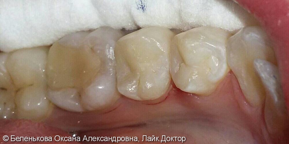Лечение кариеса двух зубов 3.4 и 3.5, до и после - фото №2