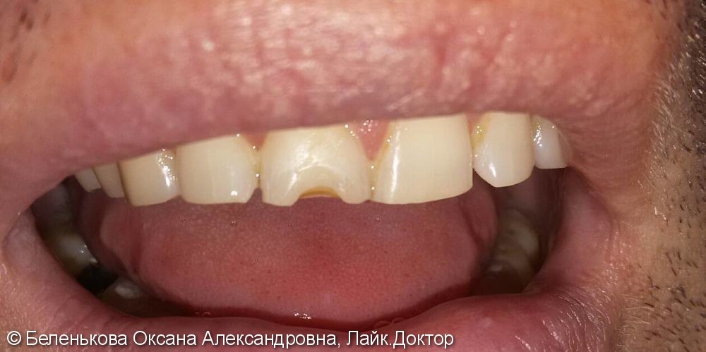 Закрытие дефекта на зубе при помощи микровинира из фотокомпозита - фото №1