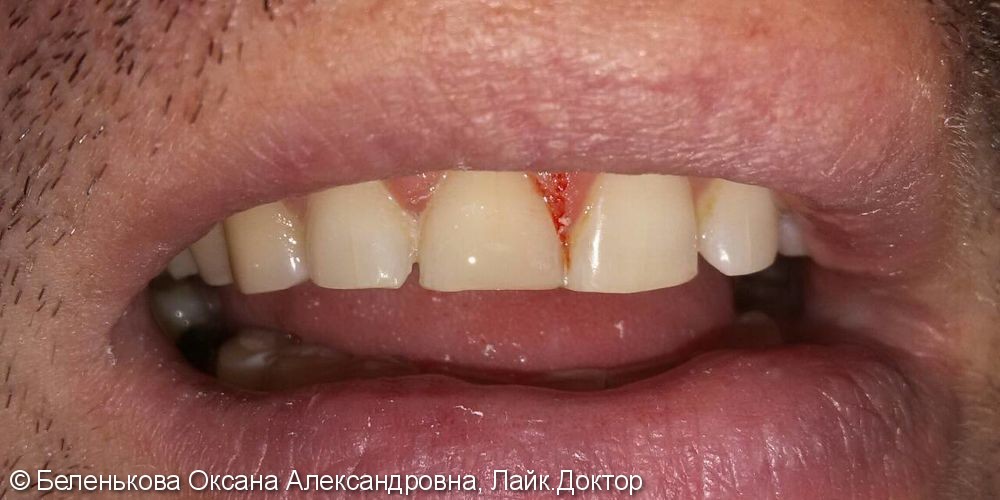Закрытие дефекта на зубе при помощи микровинира из фотокомпозита - фото №2