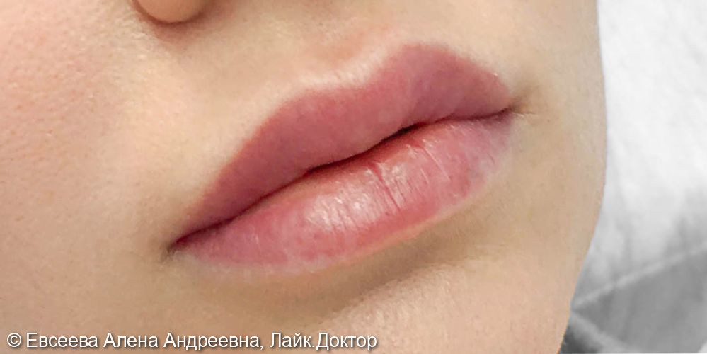 Контурная пластика губ, выполненная препаратом Ювидерм Смайл - фото №1