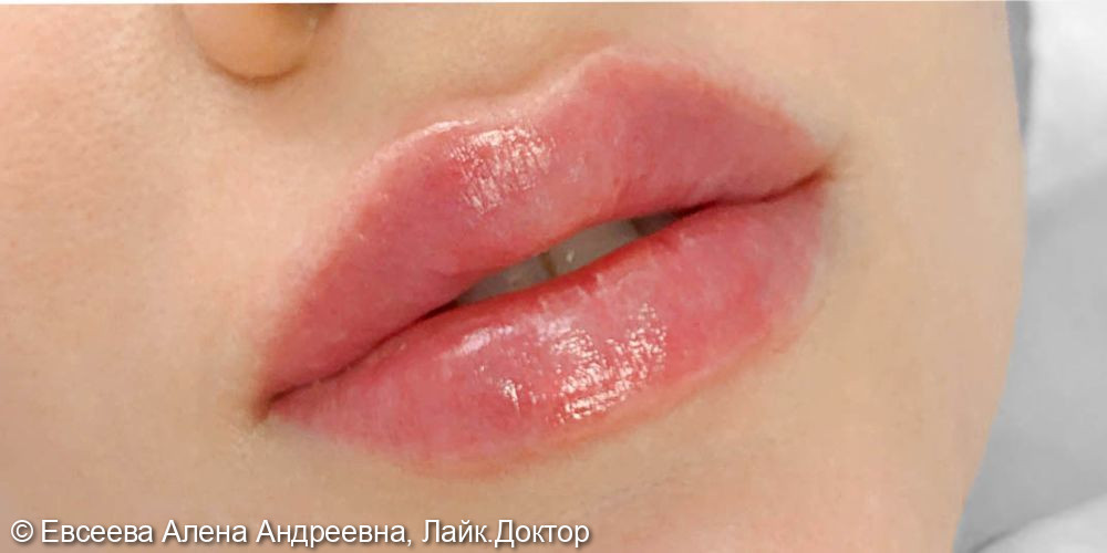 Контурная пластика губ, выполненная препаратом Ювидерм Смайл - фото №2