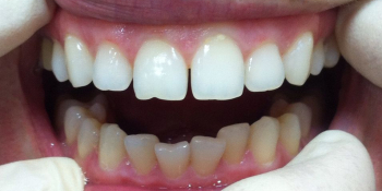 Жалобы на дефект режущего края зуба и наличие щели между центральными зубами - фото №1