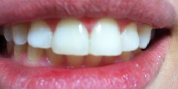 Жалобы на дефект режущего края зуба и наличие щели между центральными зубами - фото №2